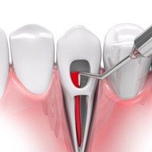 an illustration of root canal therapy in Tomball