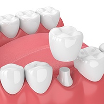 Model of an all-ceramic dental crown.