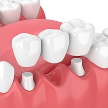 All-ceramic fixed bridge replacing a lost tooth.