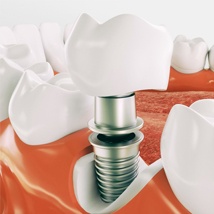 Dental implant