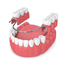 Digital model of a partial denture