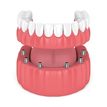 Model of implant-supported lower denture