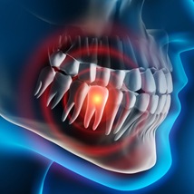 Tooth pain