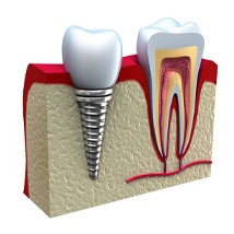 Cross-section diagram of a dental implant next to a tooth in the mouth