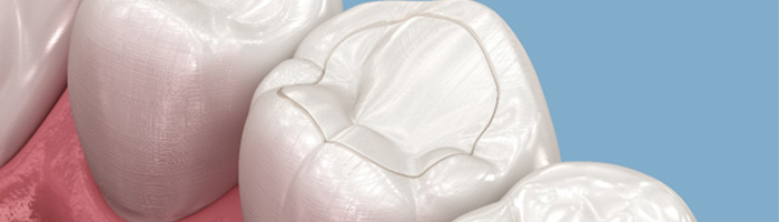 a computer generated image of a tooth-colored filling