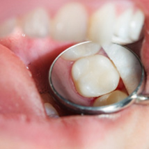 A tooth before and after receiving a tooth-colored filling