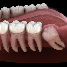 diagram of a wisdom tooth under the gums