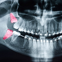 x-ray of a mouth with four teeth