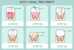 Relieve pain and infection with comfortable root canal therapy from Dr. James Geer, endodontist in Tomball. Read the details of this reliable restorative treatment.