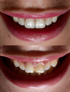 Have tooth issues that braces just won’t fix? Veneers in Tomball are the perfect solution with Dr. James Geer. 