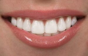 Get a flawless smile with porcelain veneers in Tomball.