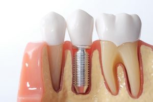 Model of dental implant