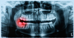 x-ray showing crooked wisdom tooth 