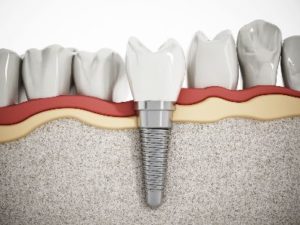 Model of an implant in a lower jaw