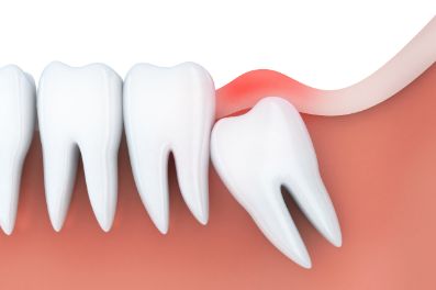 Illustration of an impacted wisdom tooth 