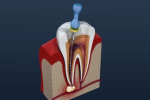 Digital model of a root canal in Tomball.