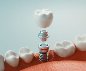 Parts of a dental implant