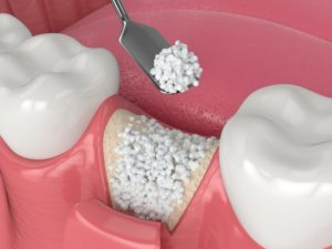 3D illustration of bone graft