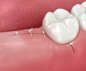 close up of wisdom tooth stitches