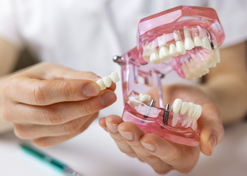Dental implant model